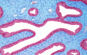 Endométriose : douleur et tabou