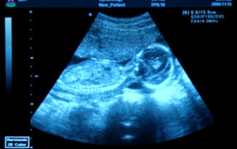 Le fœtus fait-il partie de la famille?