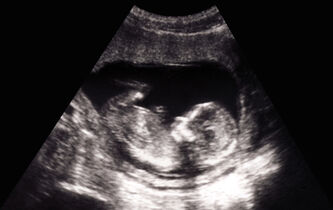 “Préjudice d’être né” : une question de justice ?