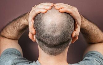 Calvitie : que perdent les hommes lorsqu’ils perdent leurs cheveux ?